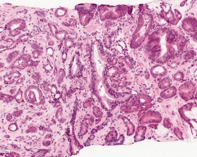 adenocarcinoma of the prostate histology